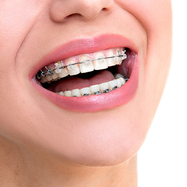 Woman with Ceramic Braces